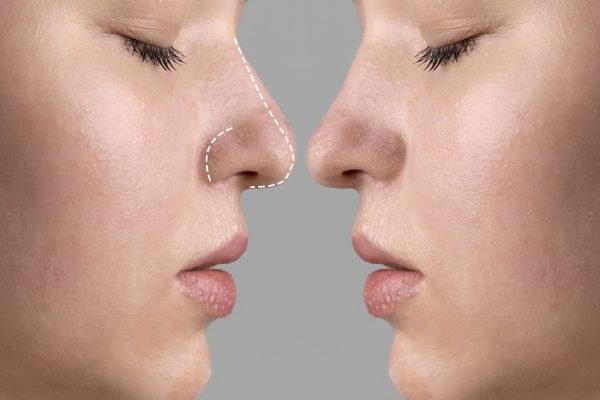 rhinoplasty-surgery-concept-with-woman-model